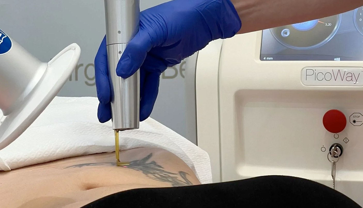 Removing Tattoos Using Laser